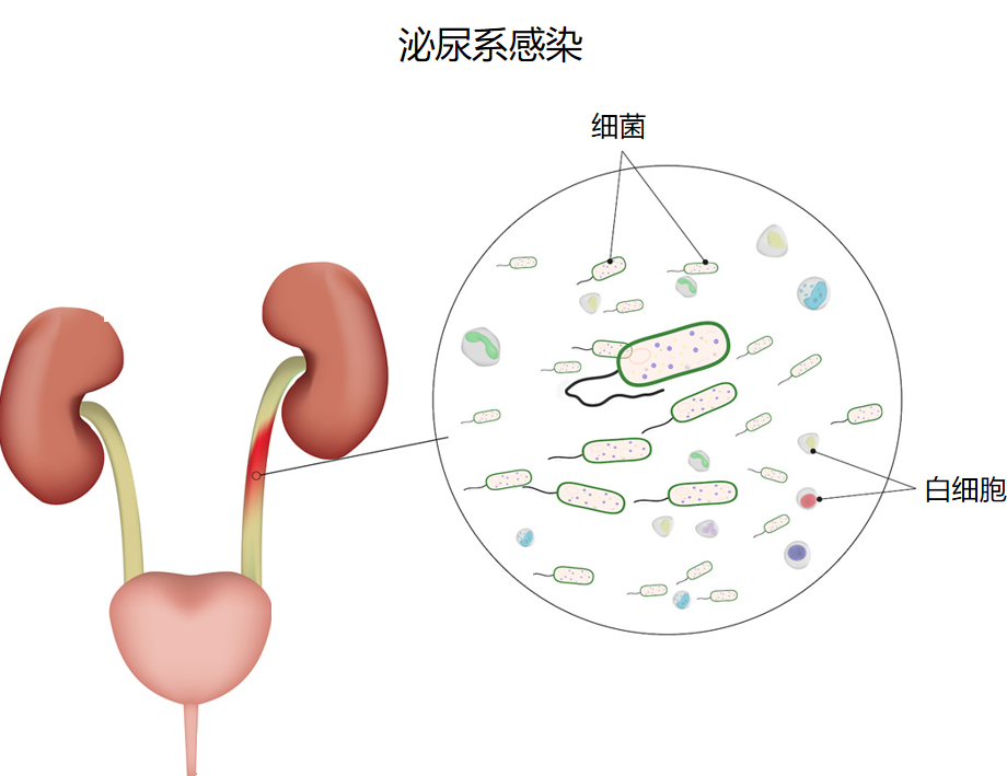 三伏天尿路結(jié)石的“高發(fā)季”，有哪些常見(jiàn)誤區(qū)