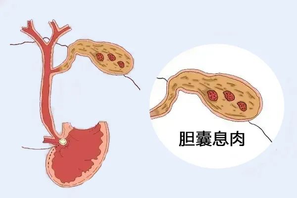 體檢出膽囊息肉，需要擔(dān)心嗎？