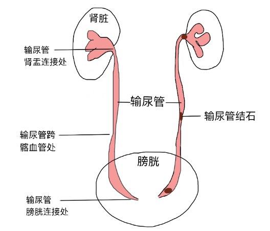 結(jié)石引發(fā)劇烈腎絞痛，該怎么辦？