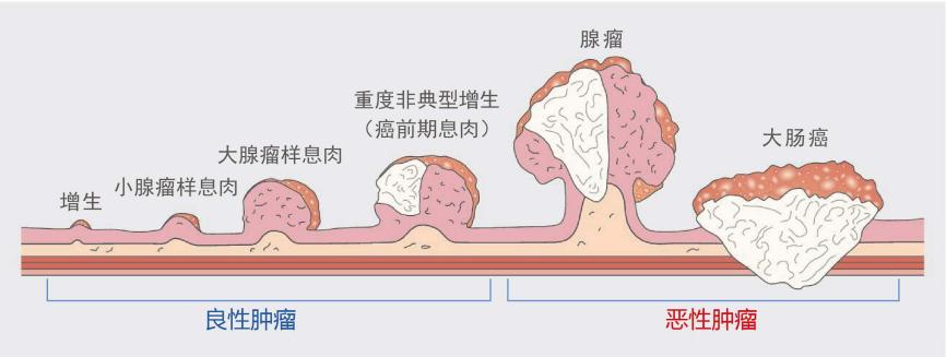 什么樣的腸息肉容易癌變？有一種要特別當(dāng)心！