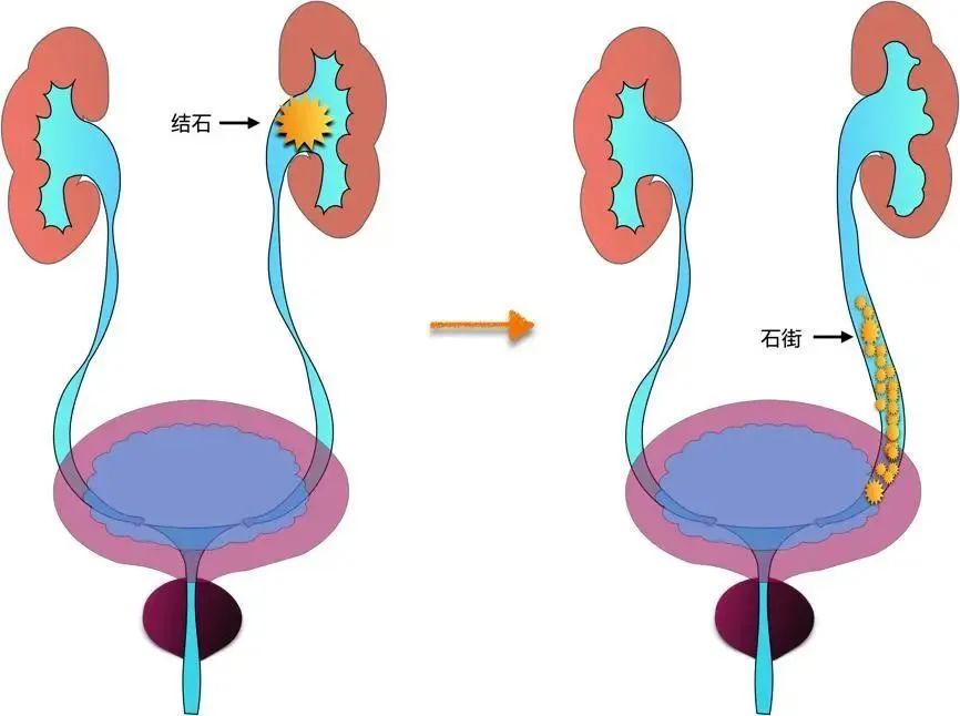 你經(jīng)歷過(guò)腎絞痛嗎？該如何緩解治療？